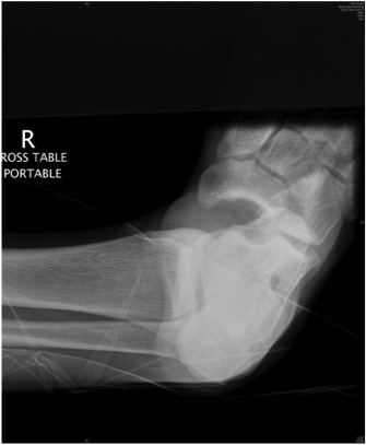 Subtalar Dislocation Xray 1